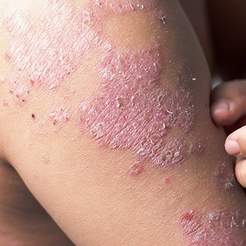 Urticaria (hives) specialist offering fast relief and effective skin care treatment in Meerut.