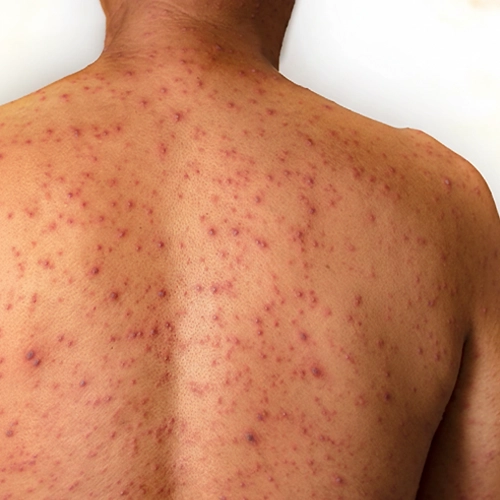 Comprehensive eczema relief and complete skin care treatment for healthier skin in Meerut.