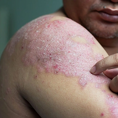 Psoriasis and Skin Allergy Treatment in Meerut
